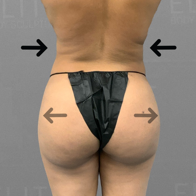 Back Fat Removal  Elite Body Sculpture