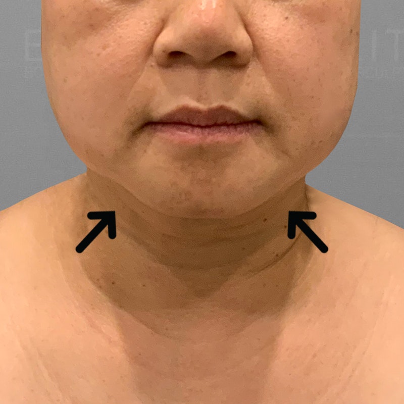 after chin airsculpt
