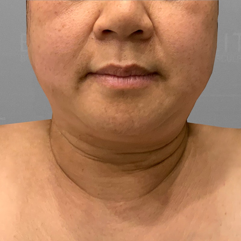 before chin airsculpt
