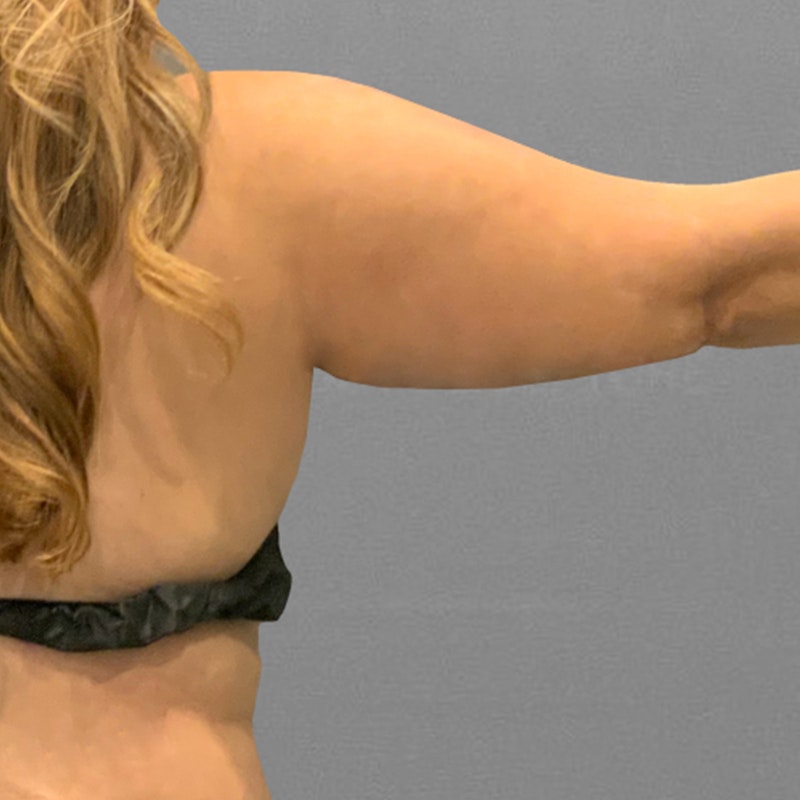 before arm airsculpt
