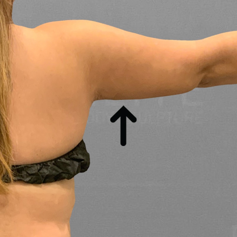 after arm airsculpt