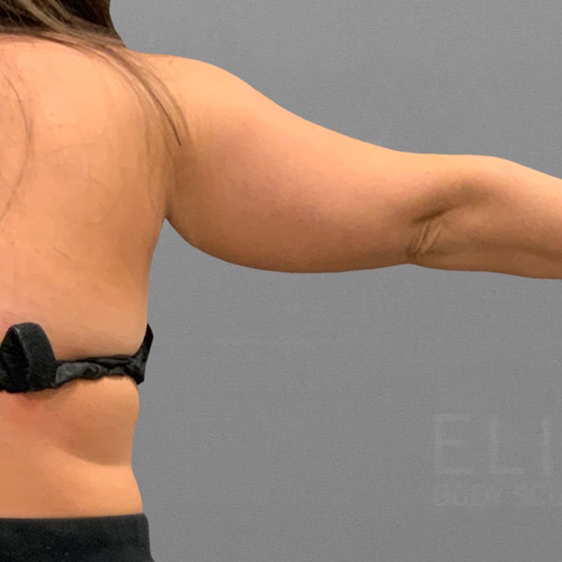 before arm fat removal