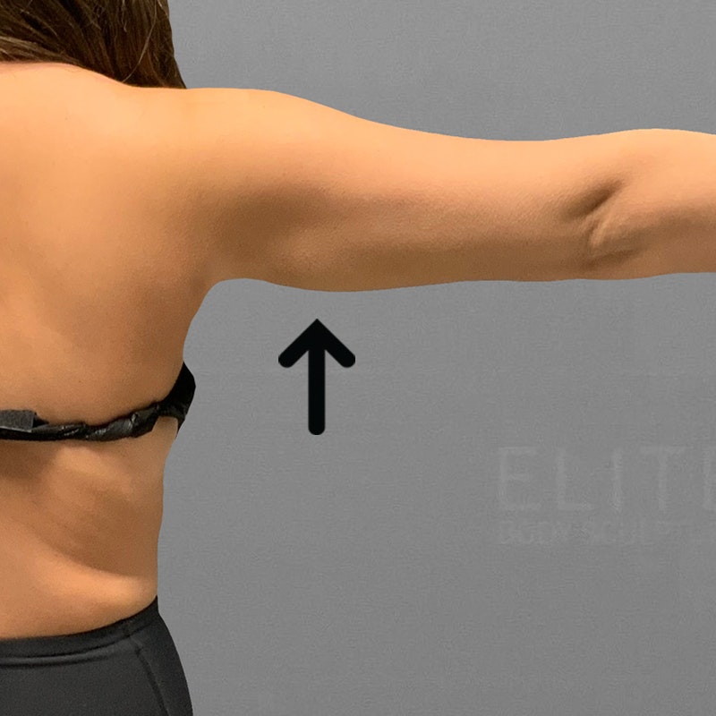 after arm fat removal