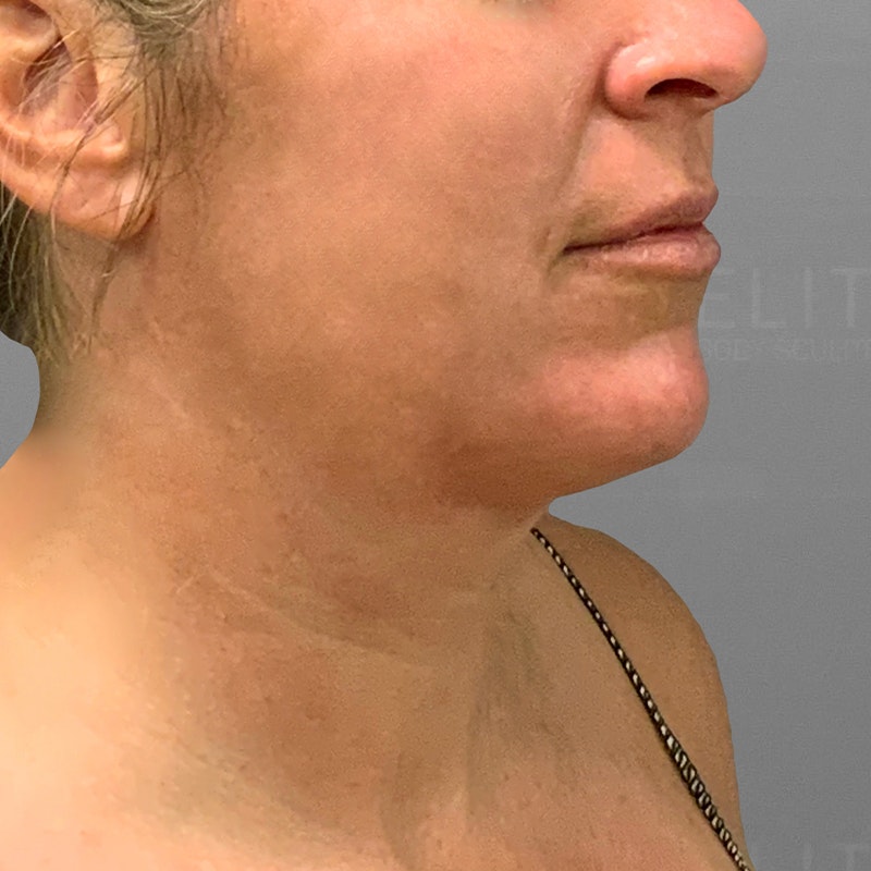before chin airsculpt