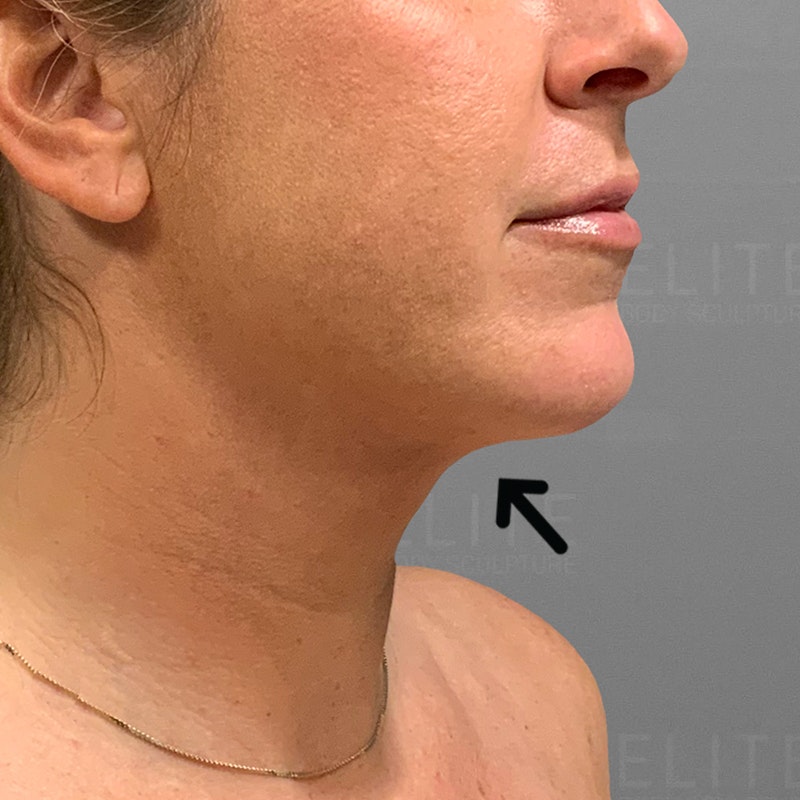 after chin airsculpt