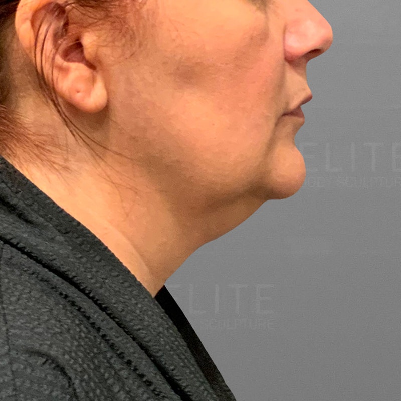 before chin airsculpt