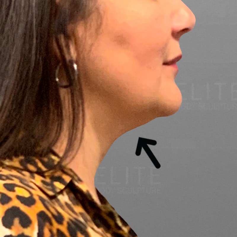 after chin airsculpt