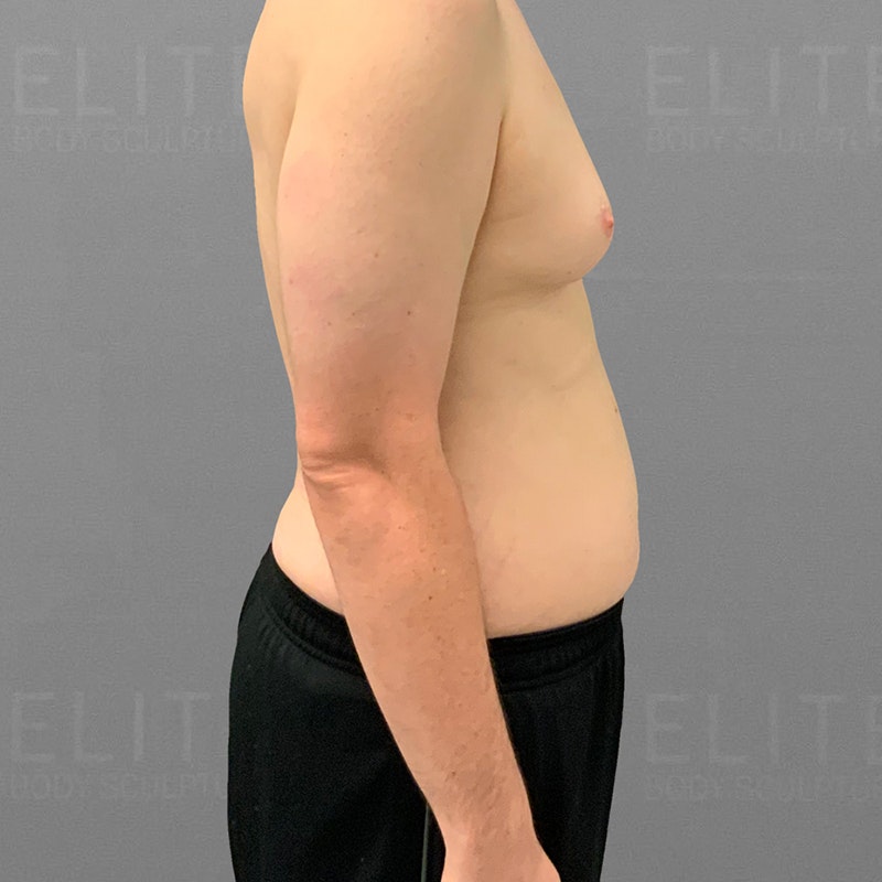 before stomach and gynecomastia liposuction