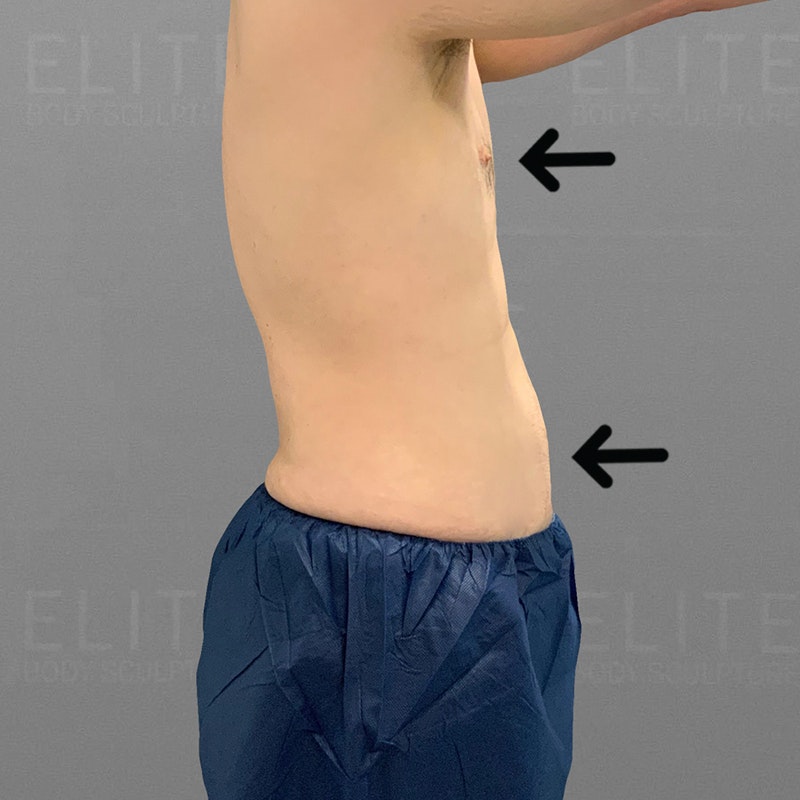 after stomach and gynecomastia liposuction