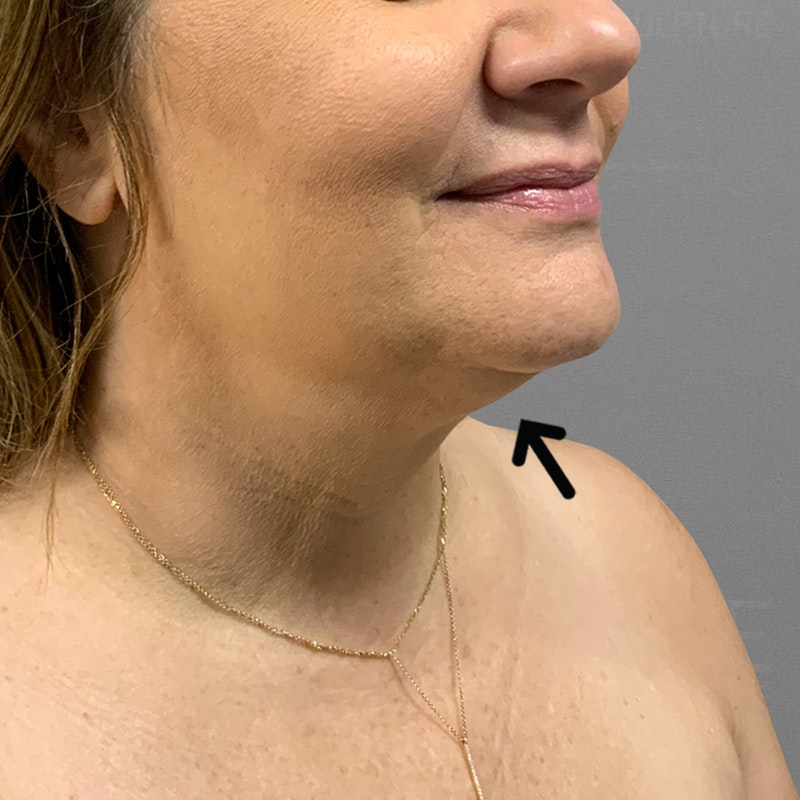 after chin lipo