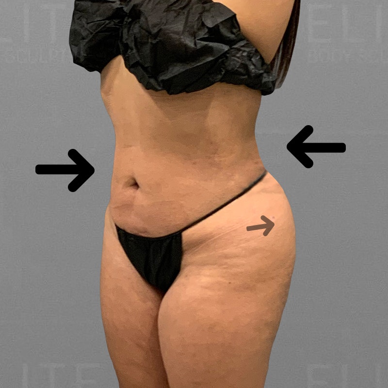 Stomach AirSculpt after