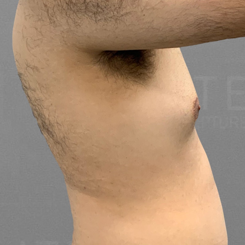 before gynecomastia airsculpt 