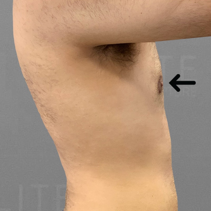 after gynecomastia airsculpt 