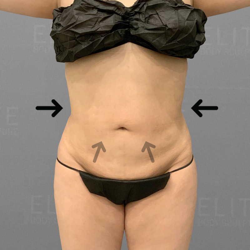 after stomach airsculpt