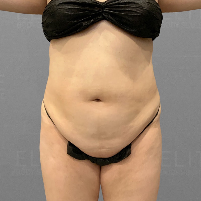 before stomach airsculpt
