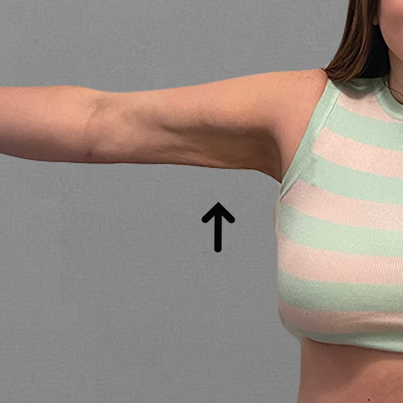 after arm liposuction
