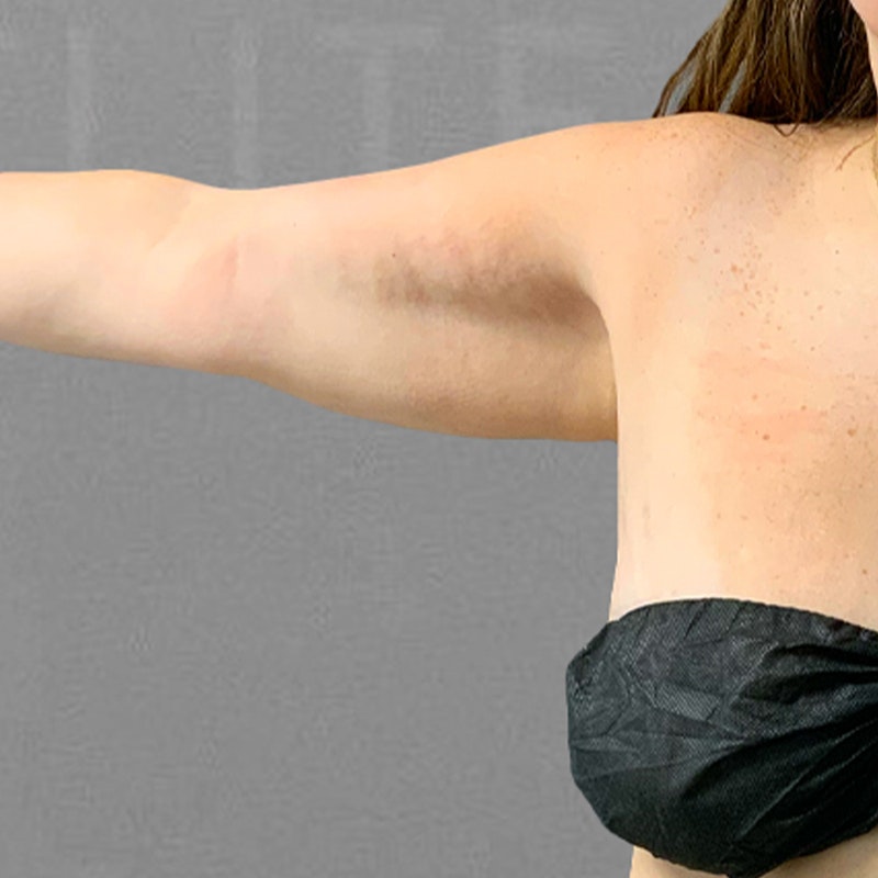 before arm liposuction