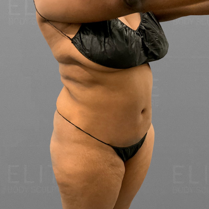 before airsculpt