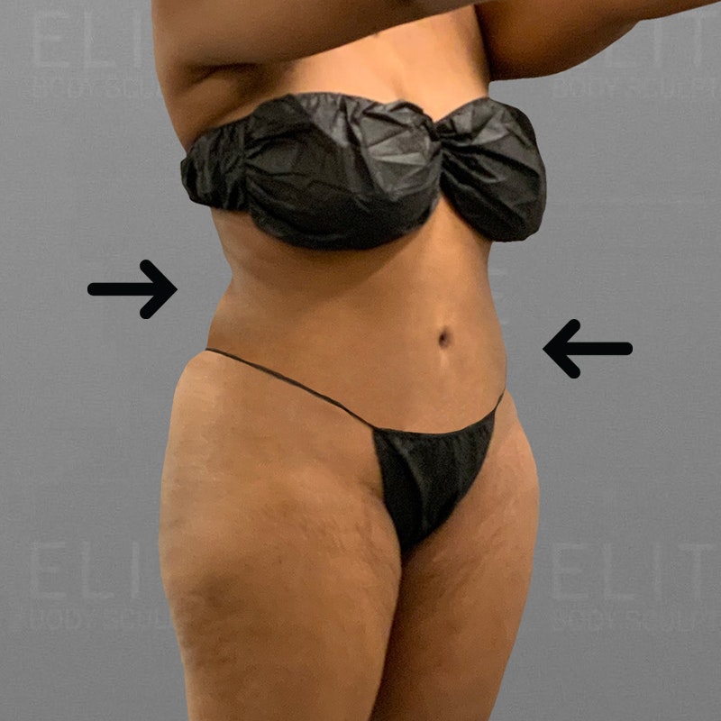 after airsculpt