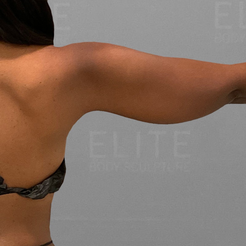 before arm liposuction