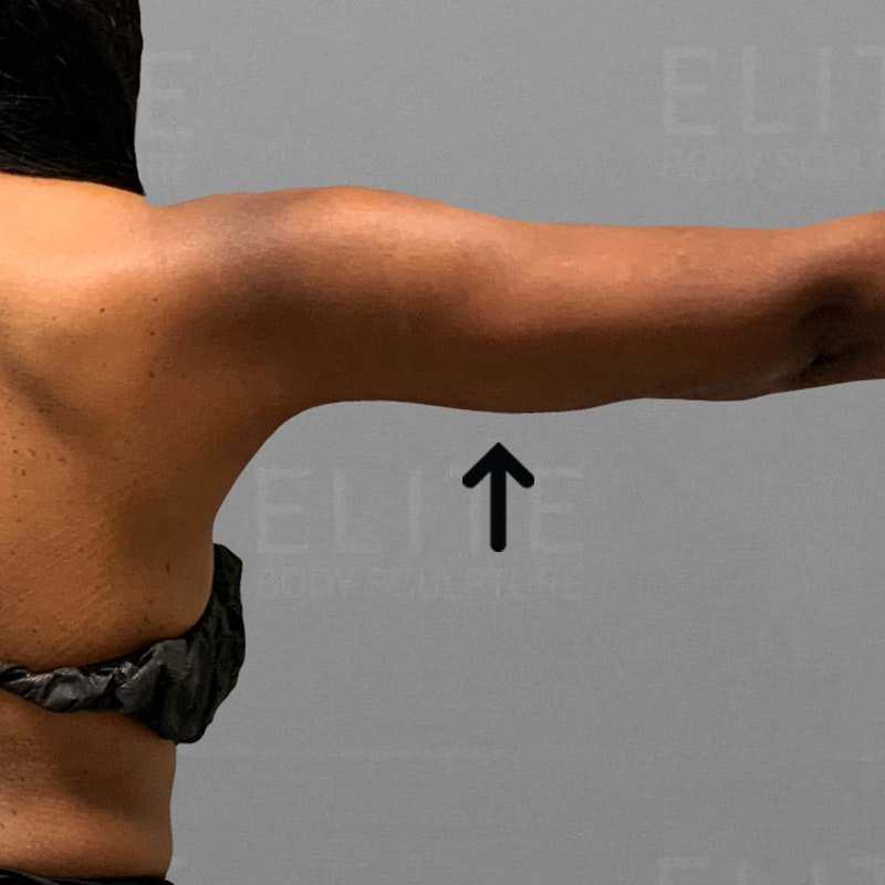 after arm liposuction