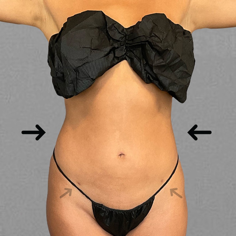after stomach airsculpt