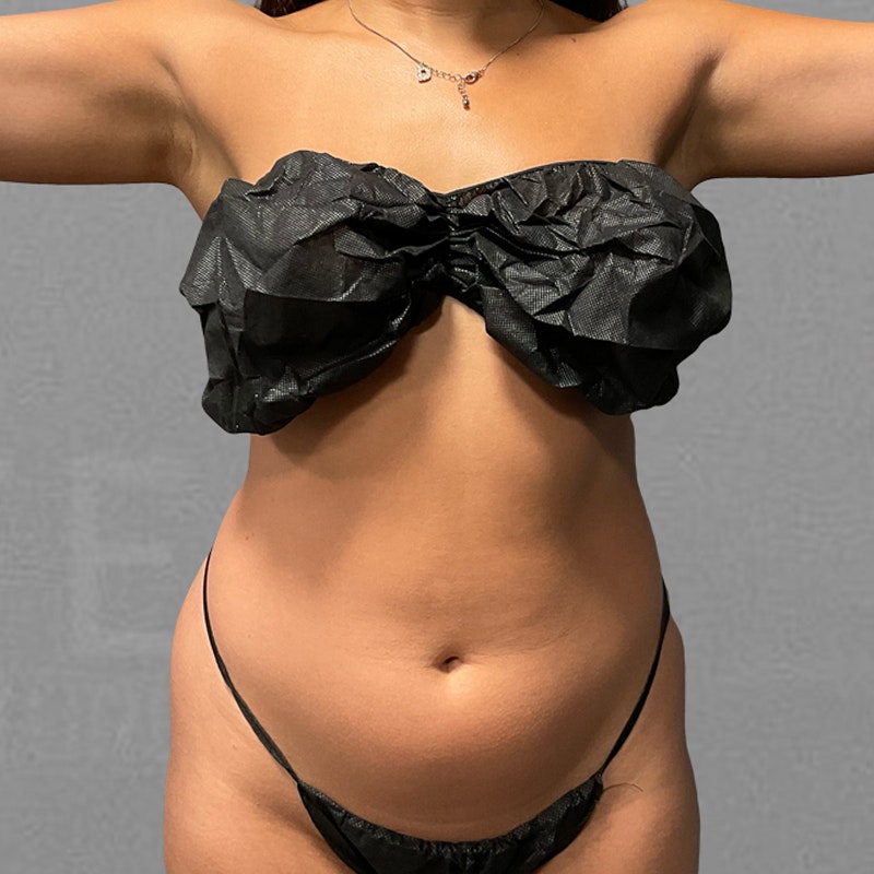 before stomach airsculpt