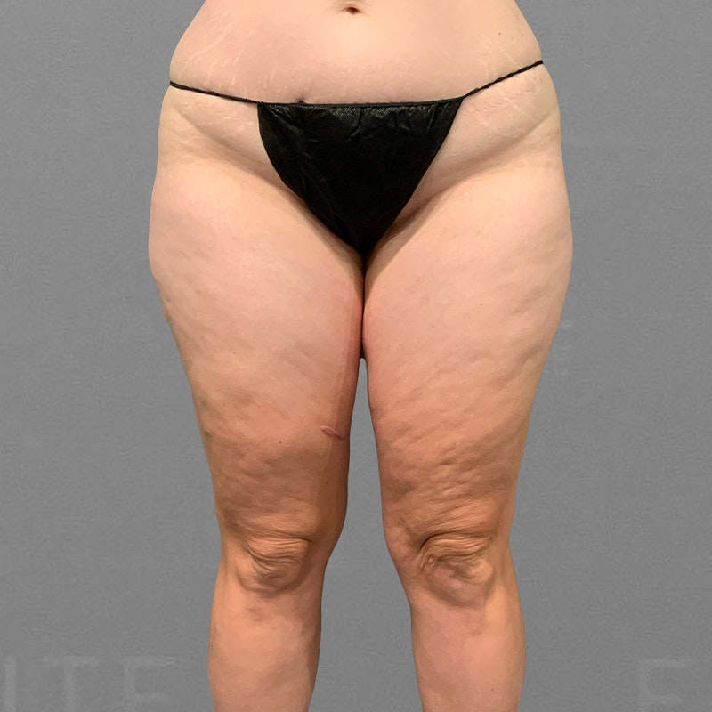 before thigh airsculpt