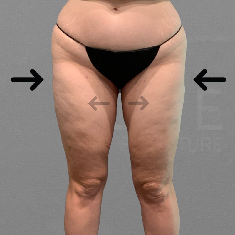 after thigh airsculpt 
