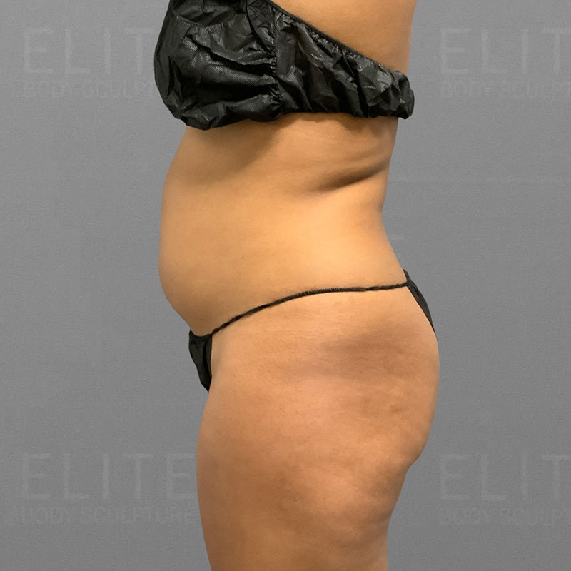 before full ab and back bra roll lipo