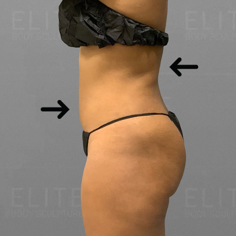 before full ab and back bra roll lipo