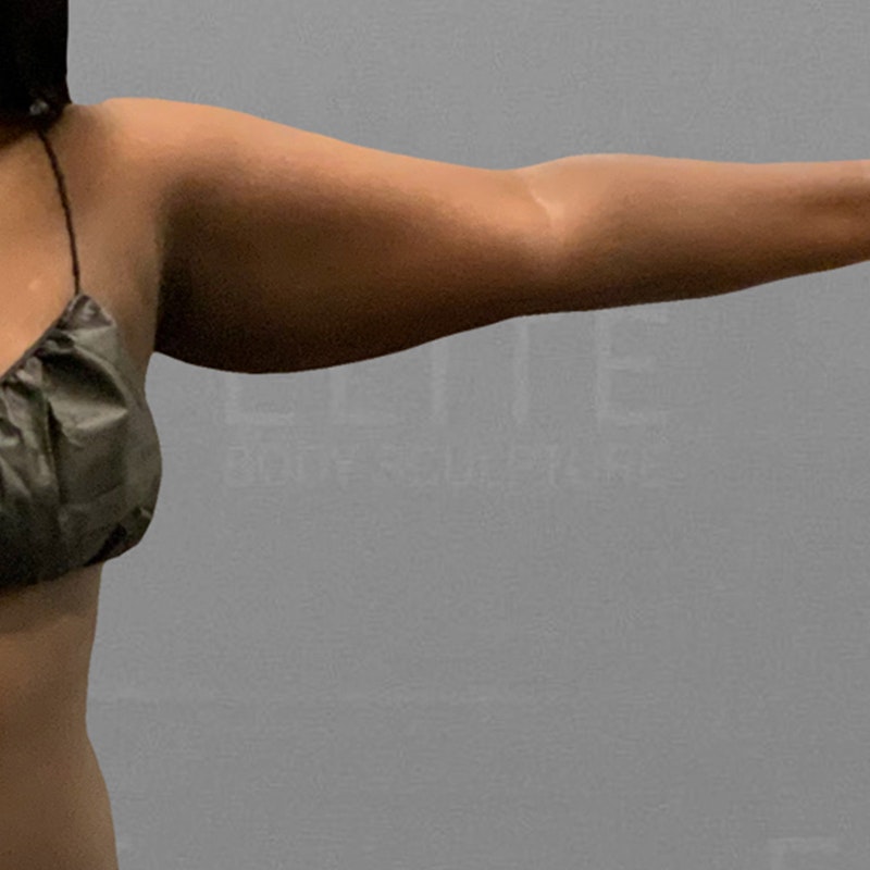 before arm airsculpt