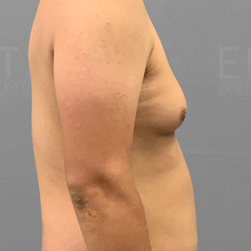 before male chest airsculpt
