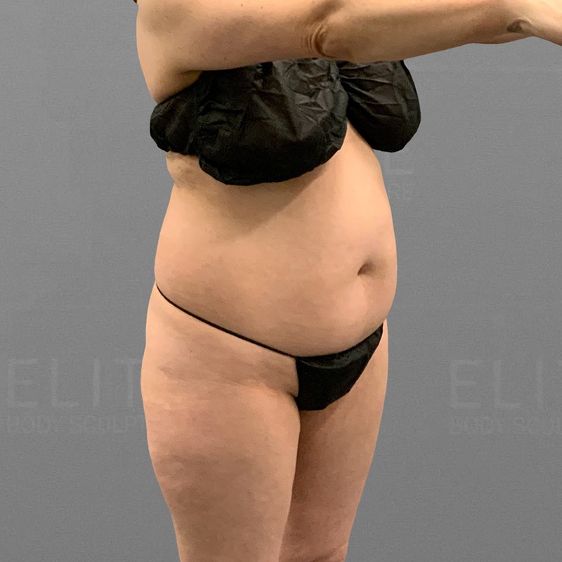 before lower back and stomach airsculpt