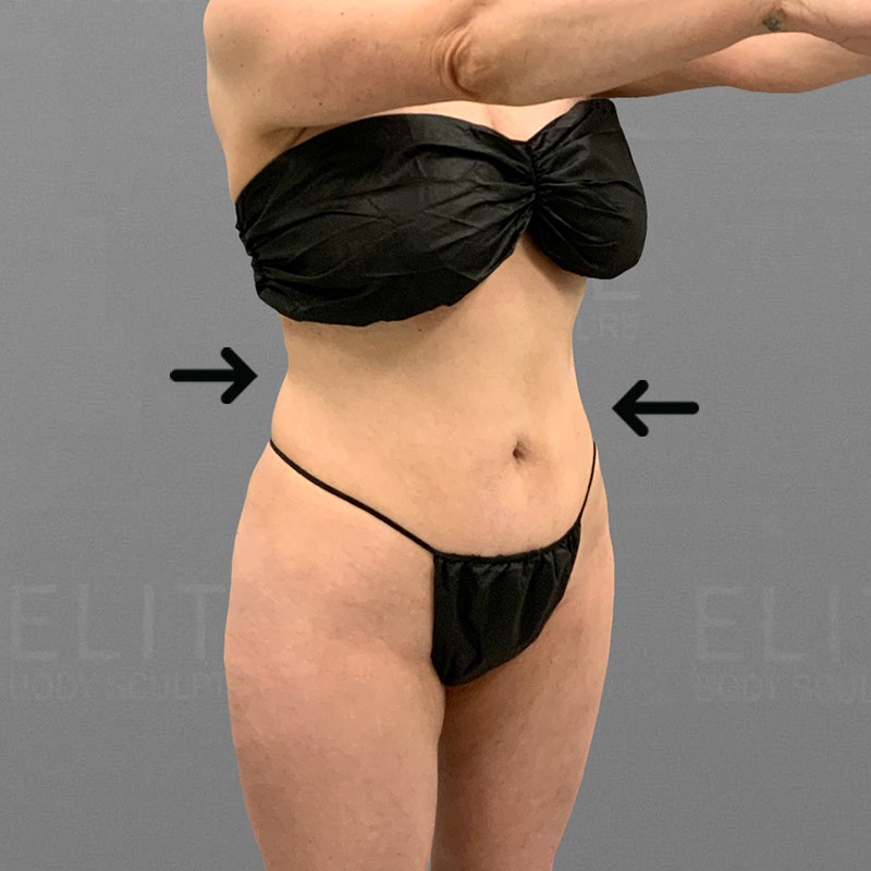 after lower back and stomach airsculpt