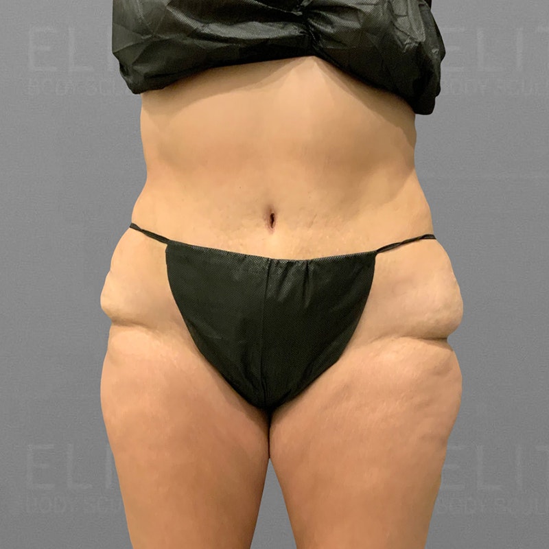 before stomach airsculpt +