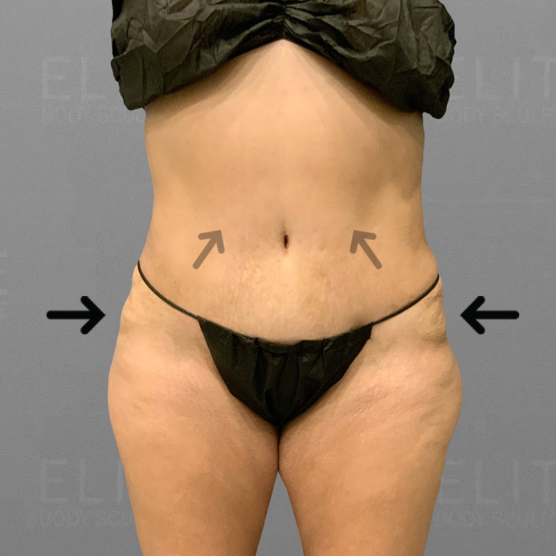 after stomach airsculpt+