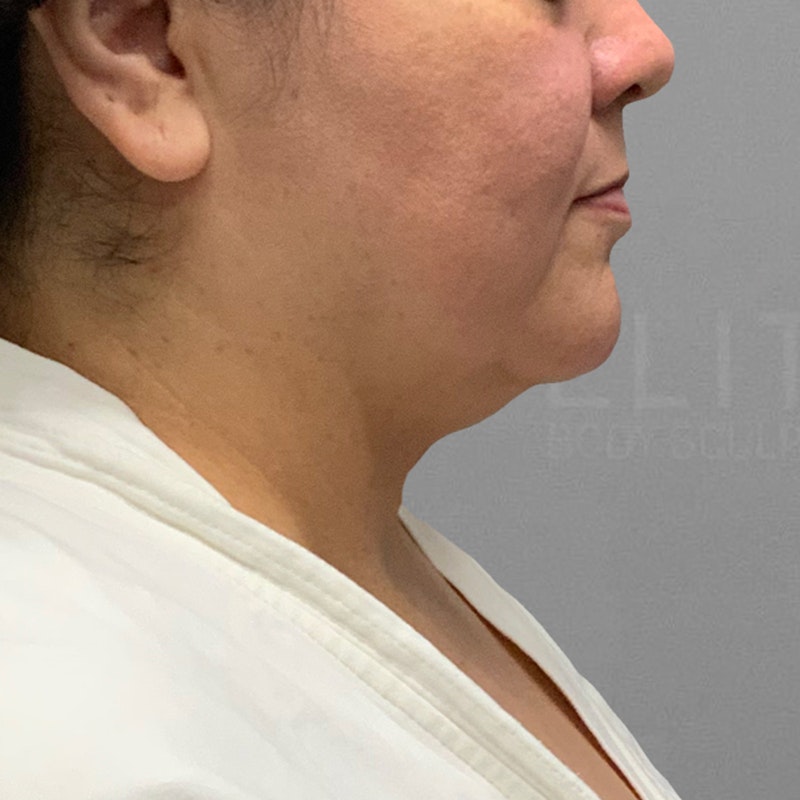 before submental airsculpt