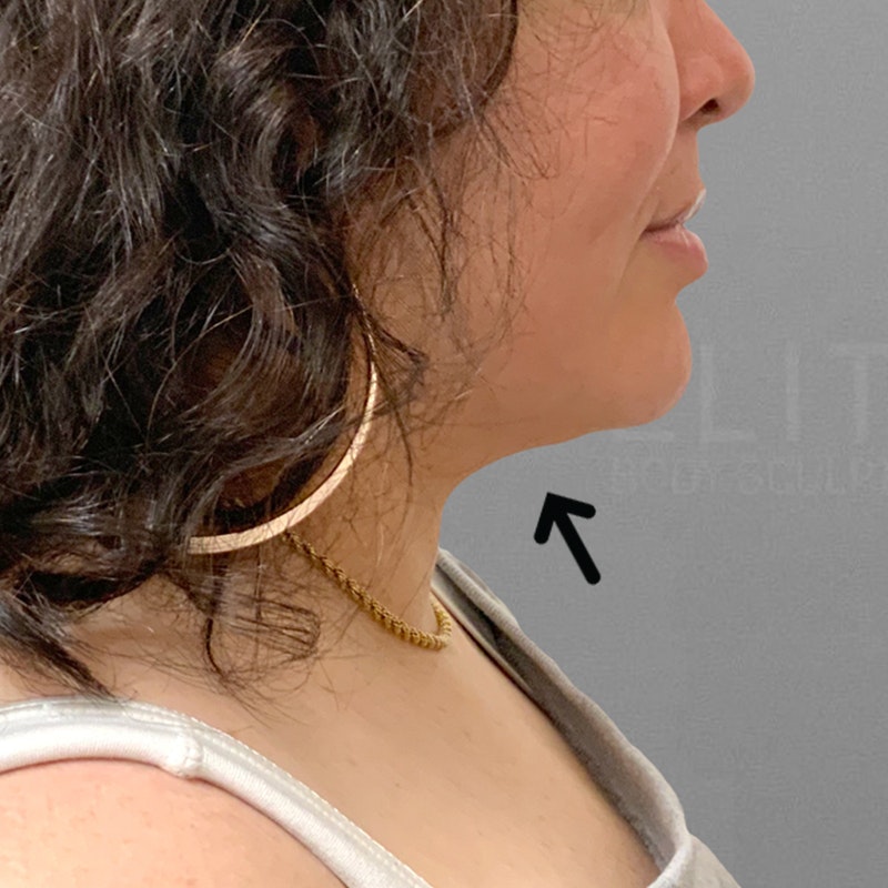 after submental airsculpt