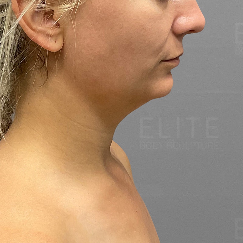 before chin airsculpt