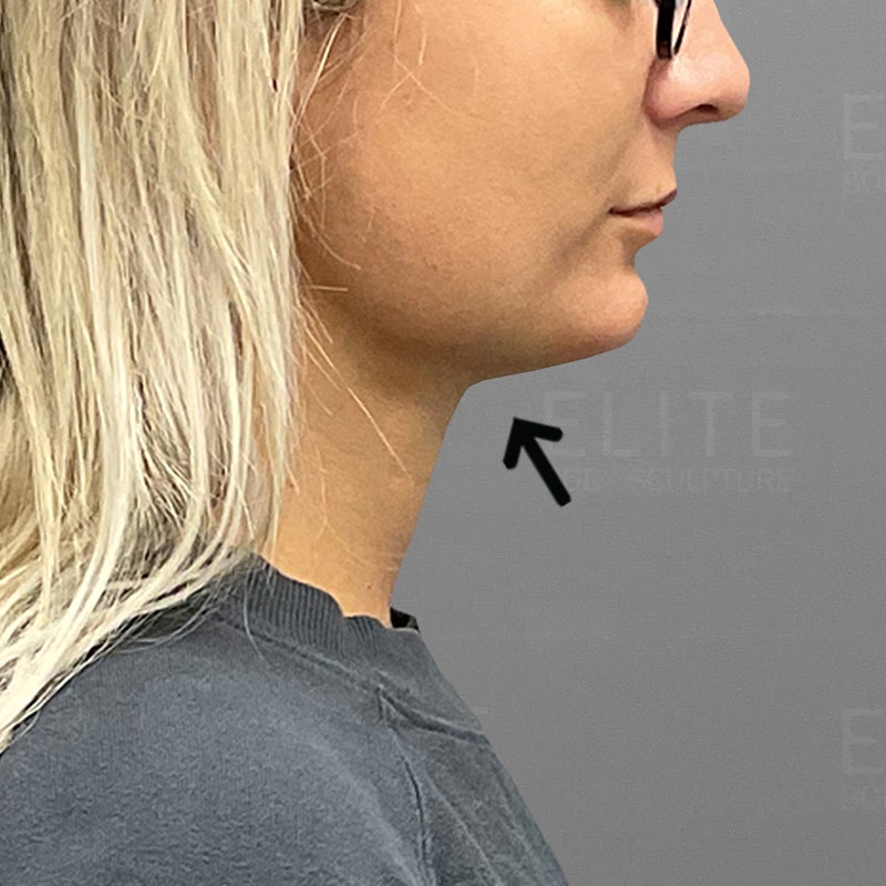 after chin airsculpt