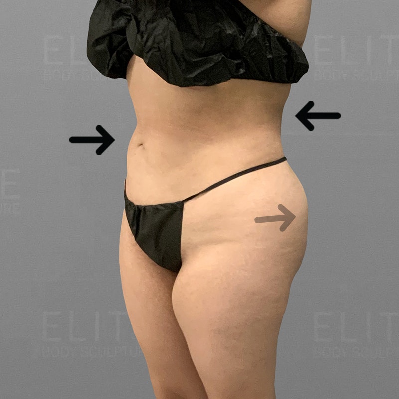 Rasi-Full Ab, BBR, Low Back, BBL-6 Month - after