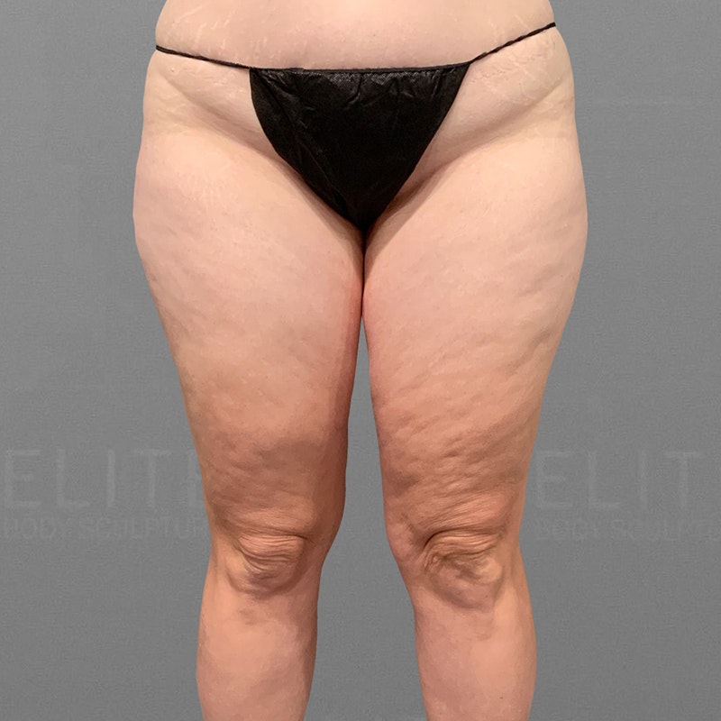 Scottsdale-Stutman-Outer Thighs, Inner Thighs, Knees-6 Month- before