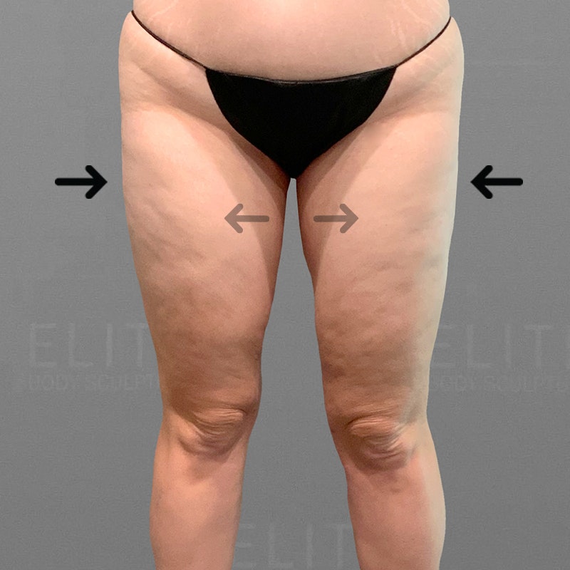 Scottsdale-Stutman-Outer Thighs, Inner Thighs, Knees-6 Month- after