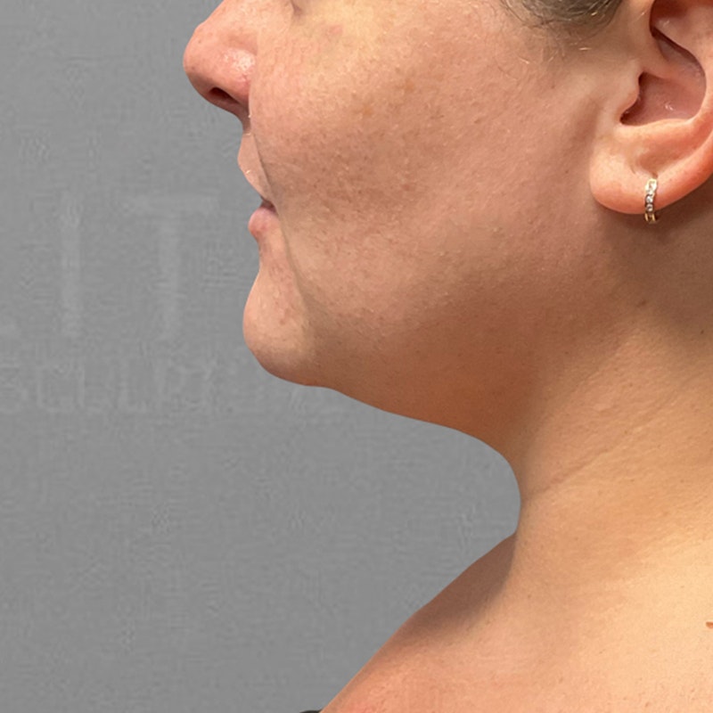 before chin airsculpt