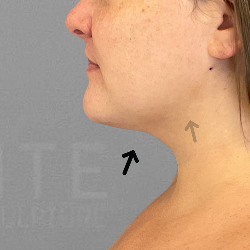 after chin airsculpt