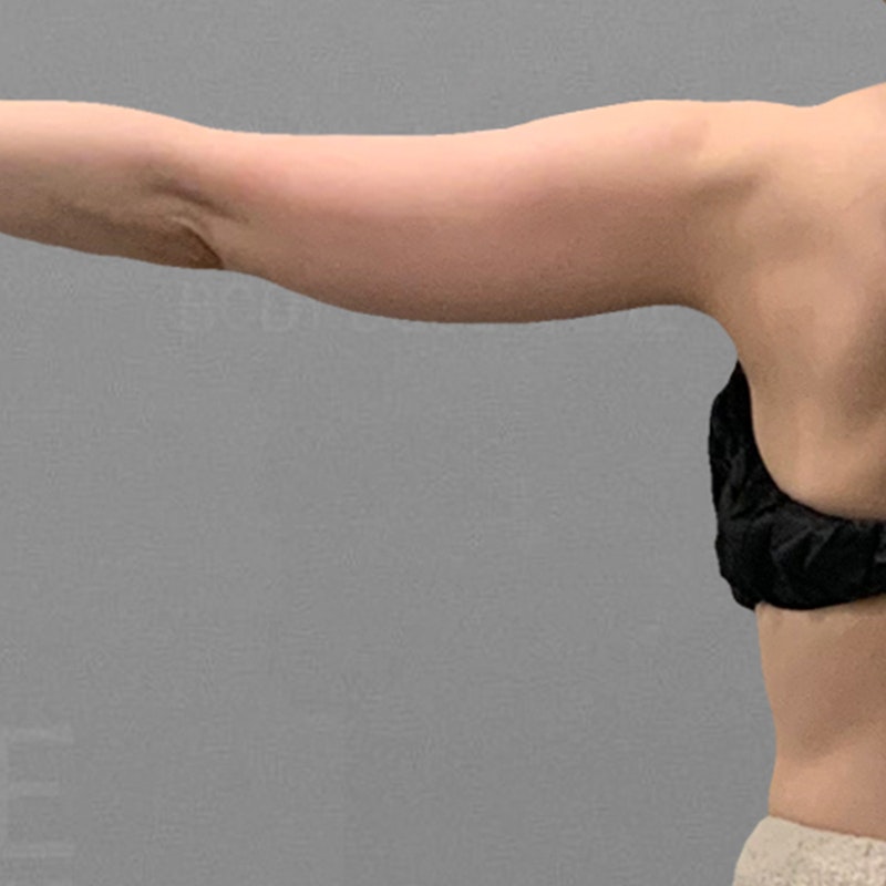 before arm airsculpt+