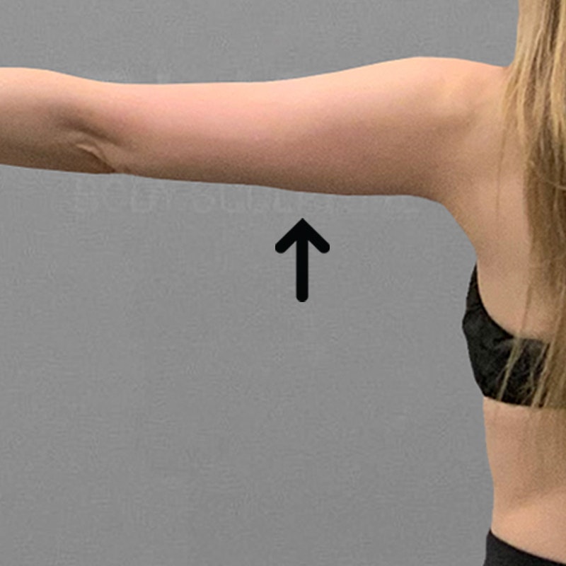 after  arm airsculpt+