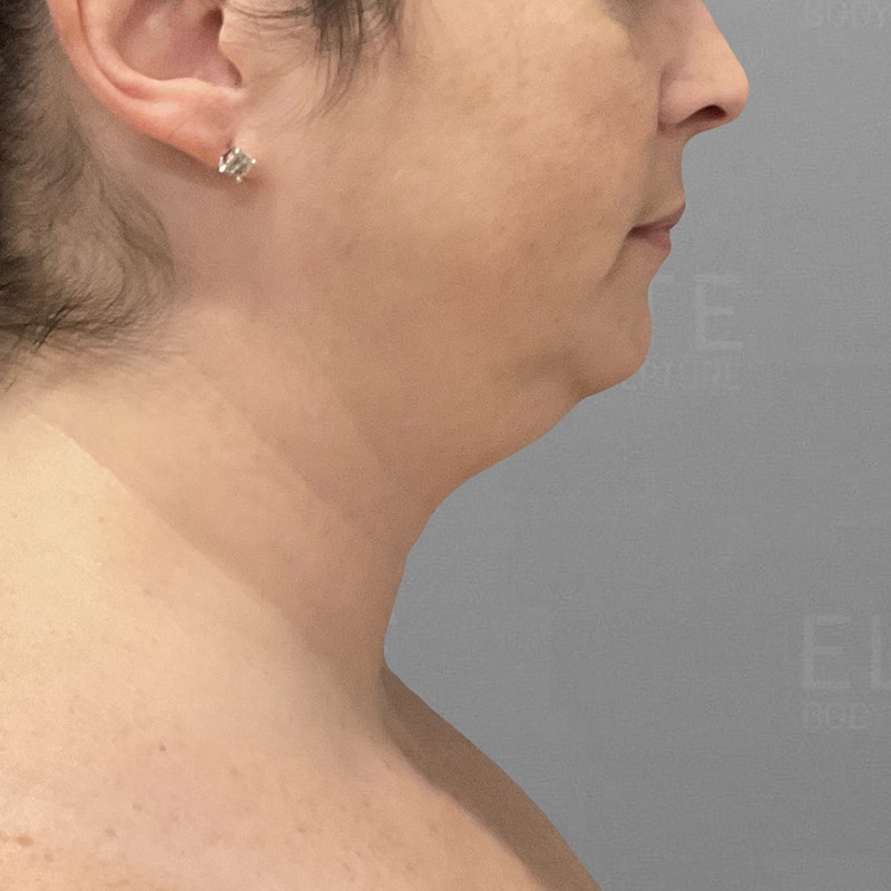 before chin airsculpt