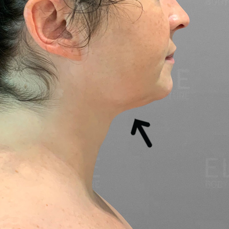 after chin airsculpt